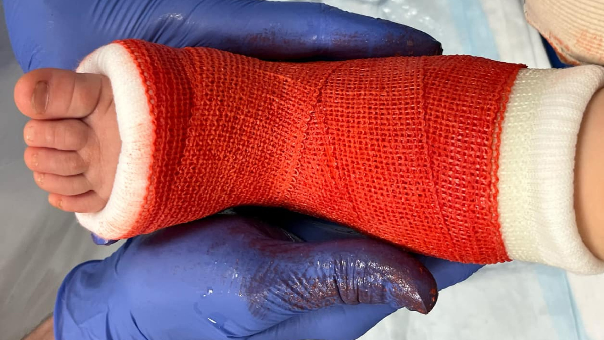 en barnfot med gips och ett rött bandage