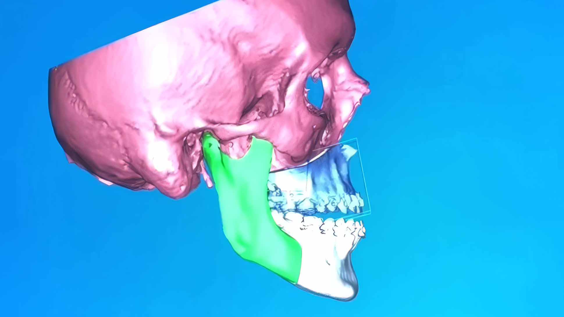 En 3D-bild på en människoskalle med käken i en annan färg. 