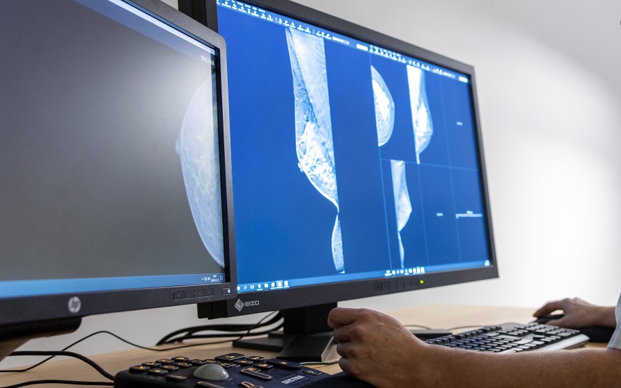 AI-assisted breast cancer screening: Promising results but many questions remain